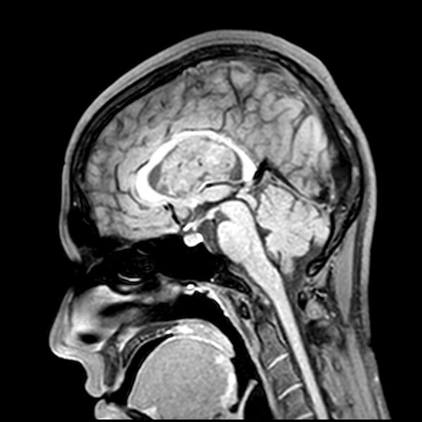 File:Central neurocytoma (Radiopaedia 79320-92380 Sagittal T1 130).jpg