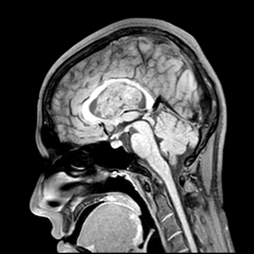 Central neurocytoma (Radiopaedia 79320-92380 Sagittal T1 130).jpg