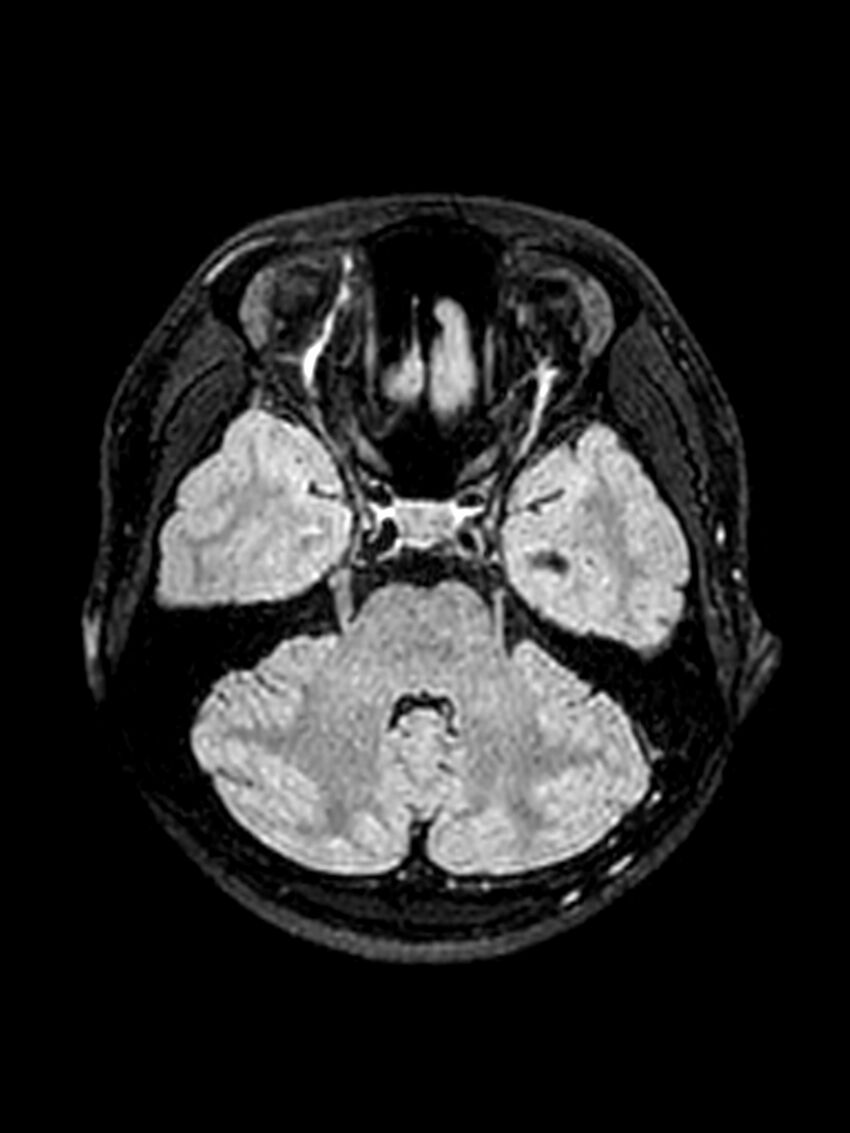 Central neurocytoma (Radiopaedia 79320-92381 Axial FLAIR 118).jpg