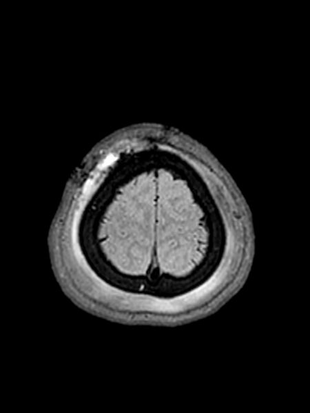 File:Central neurocytoma (Radiopaedia 79320-92381 Axial FLAIR 31).jpg