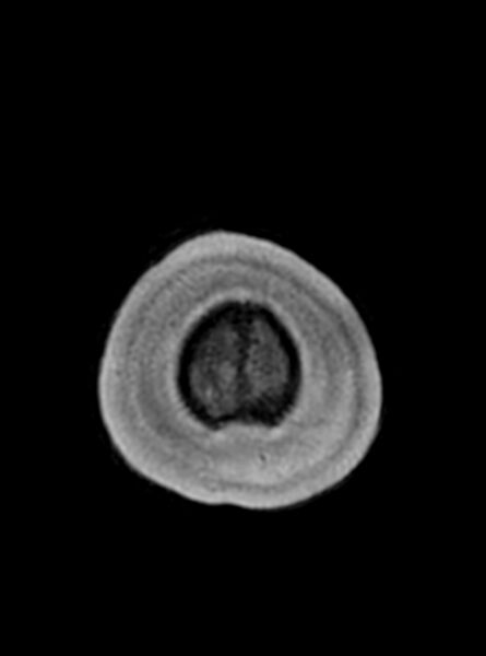 File:Central neurocytoma (Radiopaedia 79320-92381 Axial T1 38).jpg
