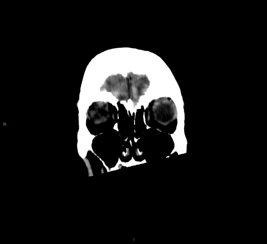 Cerebellar hemorrhage (Radiopaedia 58792-66026 Coronal non-contrast 55).jpg
