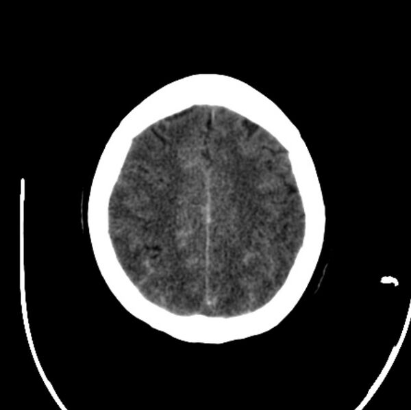 File:Cerebellar hemorrhage causing obstructive hydrocephalus (Radiopaedia 33989-35207 Axial non-contrast 41).jpg