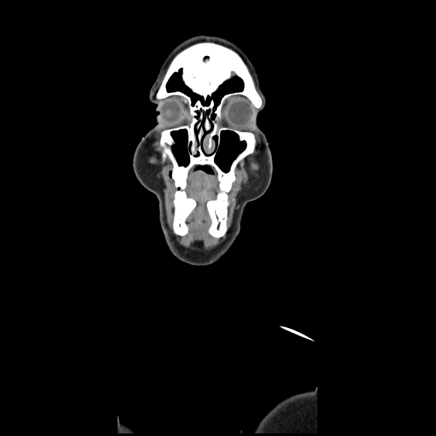 Cerebellar infarct due to vertebral artery dissection with posterior fossa decompression (Radiopaedia 82779-97029 D 7).png