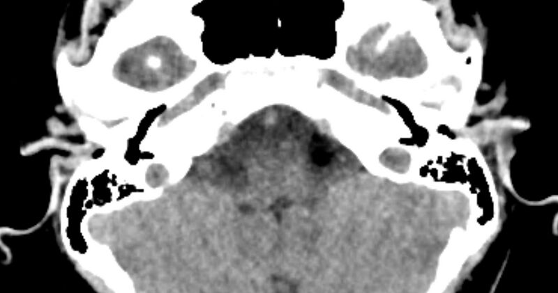 File:Cerebellopontine angle lipoma (Radiopaedia 57303-64242 B 23).jpg