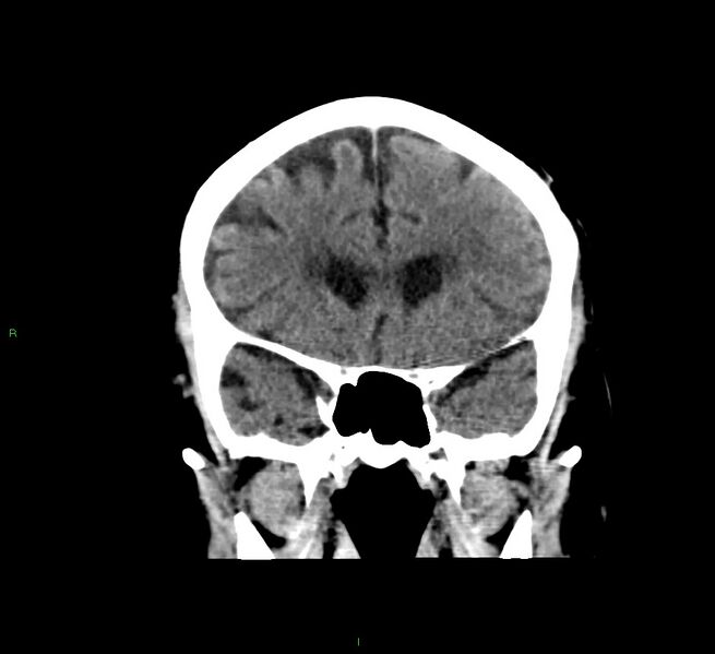 File:Cerebral amyloid angiopathy-associated lobar intracerebral hemorrhage (Radiopaedia 58376-65511 Coronal non-contrast 44).jpg