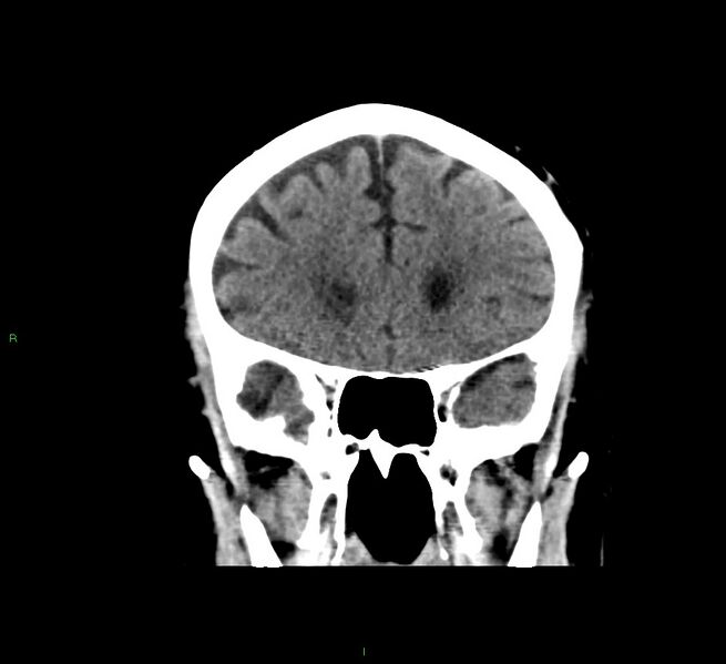 File:Cerebral amyloid angiopathy-associated lobar intracerebral hemorrhage (Radiopaedia 58376-65511 Coronal non-contrast 46).jpg