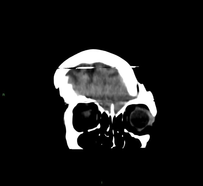 File:Cerebral amyloid angiopathy-associated lobar intracerebral hemorrhage (Radiopaedia 58377-65514 Coronal non-contrast 56).jpg