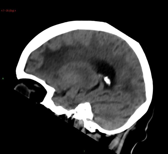 File:Cerebral amyloid angiopathy-associated lobar intracerebral hemorrhage (Radiopaedia 58378-65518 C 26).jpg