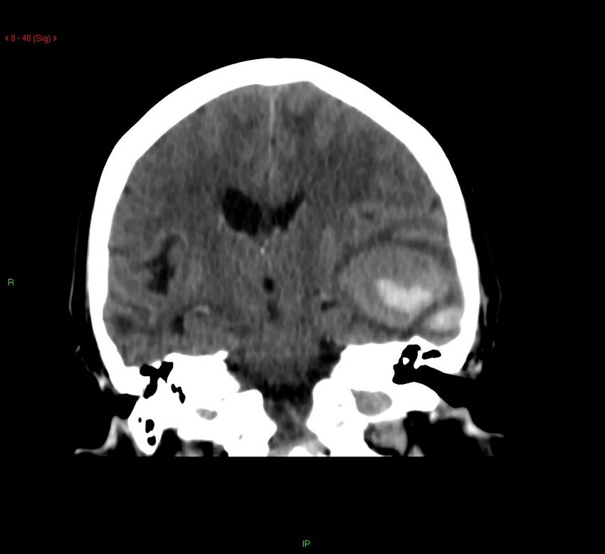 Cerebral amyloid angiopathy-associated lobar intracerebral hemorrhage (Radiopaedia 58378-65518 Coronal non-contrast 40).jpg