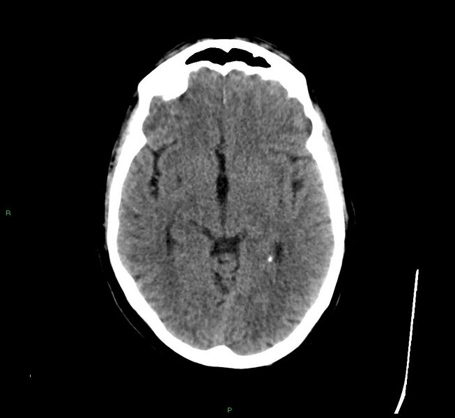 File:Cerebral amyloid angiopathy-associated lobar intracerebral hemorrhage (Radiopaedia 58529-65681 Axial non-contrast 30).jpg