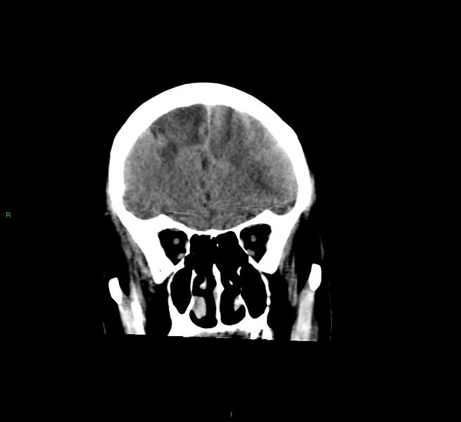 File:Cerebral amyloid angiopathy-associated lobar intracerebral hemorrhage (Radiopaedia 58529-65681 Coronal non-contrast 50).jpg