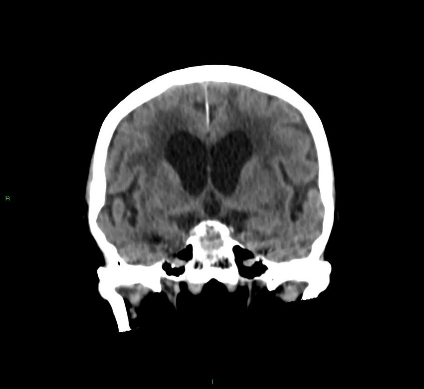 Cerebral amyloid angiopathy-associated lobar intracerebral hemorrhage (Radiopaedia 58530-65688 Coronal non-contrast 40).jpg