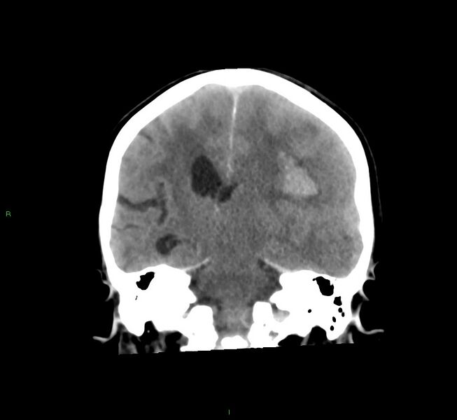 File:Cerebral amyloid angiopathy-associated lobar intracerebral hemorrhage (Radiopaedia 58561-65724 Coronal non-contrast 29).jpg