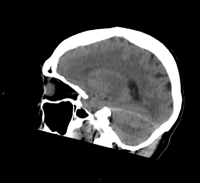 File:Cerebral amyloid angiopathy-associated lobar intracerebral hemorrhage (Radiopaedia 58756-65977 C 38).jpg