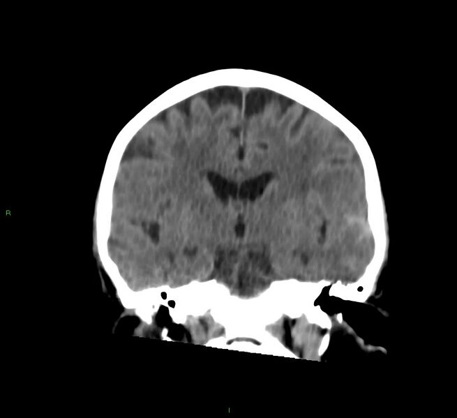 File:Cerebral amyloid angiopathy-associated lobar intracerebral hemorrhage (Radiopaedia 58757-65978 Coronal non-contrast 37).jpg