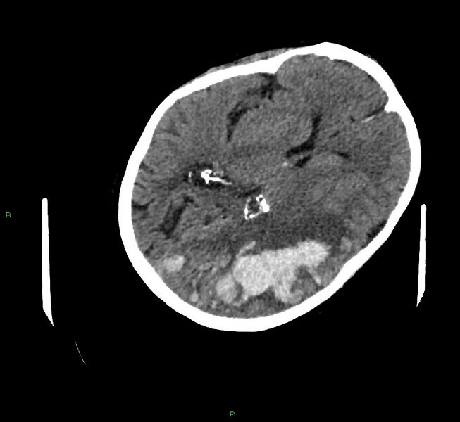 File:Cerebral amyloid angiopathy-associated lobar intracerebral hemorrhage (Radiopaedia 58757-65979 Axial non-contrast 64).jpg