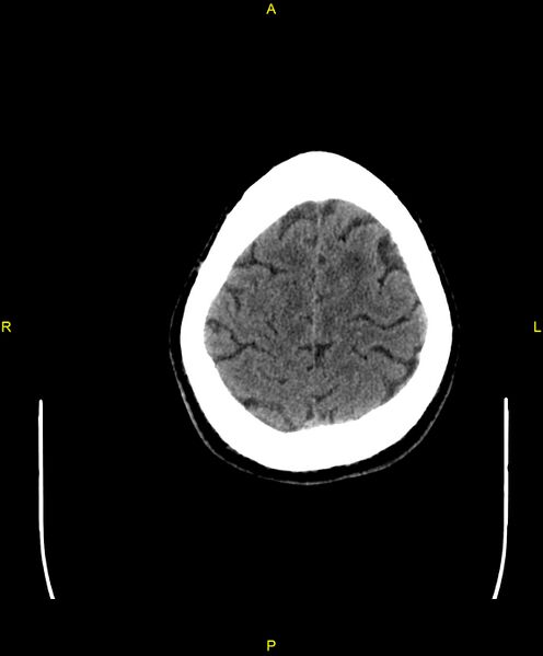 File:Cerebral autosomal dominant arteriopathy with subcortical infarcts and leukoencephalopathy (CADASIL) (Radiopaedia 86108-102051 Axial non-contrast 97).jpg