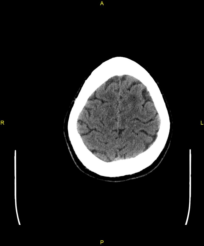 Cerebral autosomal dominant arteriopathy with subcortical infarcts and leukoencephalopathy (CADASIL) (Radiopaedia 86108-102051 Axial non-contrast 97).jpg