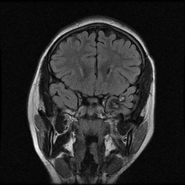 File:Cerebral cavernous malformation (Radiopaedia 44301-47942 Coronal FLAIR 4).jpg