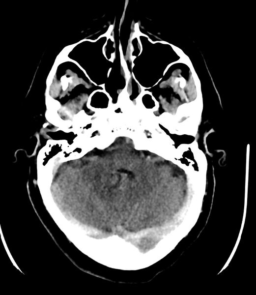 File:Cerebral dural venous sinus thrombosis (Radiopaedia 86514-102575 Axial non-contrast 11).jpg