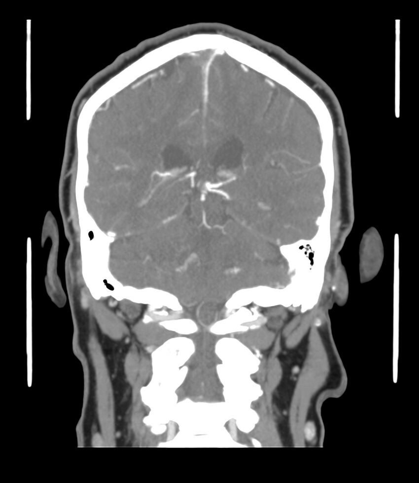 Cerebral dural venous sinus thrombosis (Radiopaedia 86514-102576 B 47).jpg