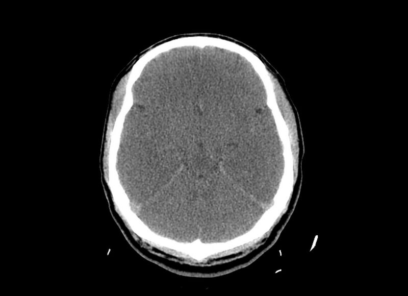 File:Cerebral edema (Radiopaedia 82519-96661 Axial non-contrast 34).jpg