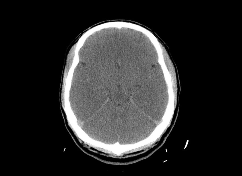 Cerebral edema (Radiopaedia 82519-96661 Axial non-contrast 34).jpg