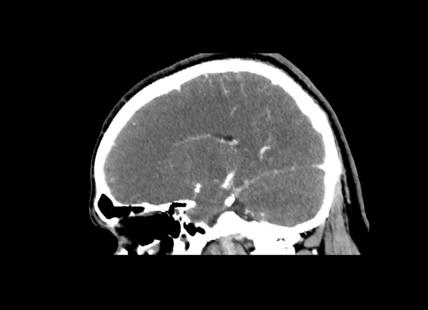 Cerebral edema (Radiopaedia 82519-96661 D 22).jpg