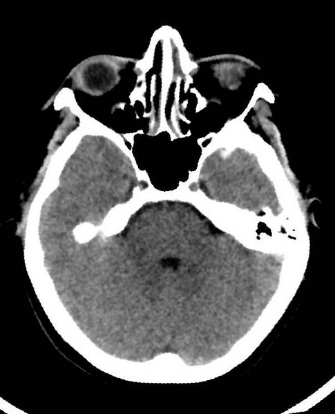 File:Cerebral edema due to severe hyponatremia (Radiopaedia 89826-106938 Axial non-contrast 32).jpg