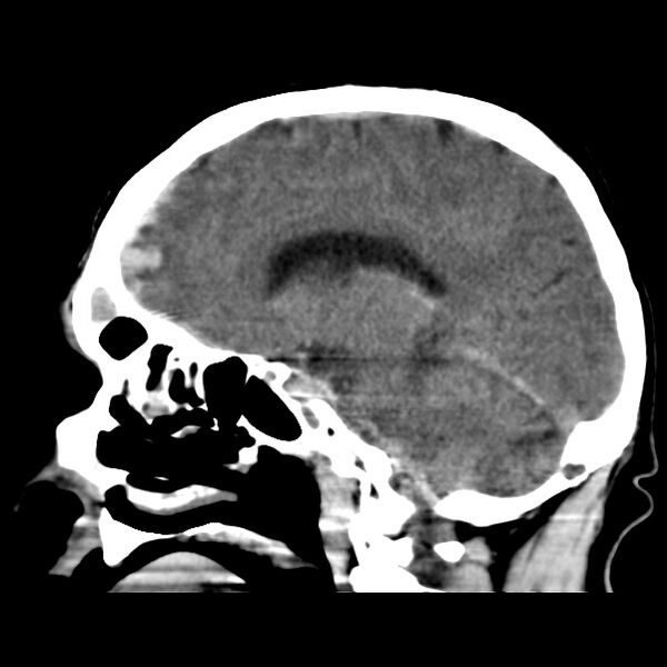 File:Cerebral hemorrhagic contusions (Radiopaedia 23145-23188 C 19).jpg