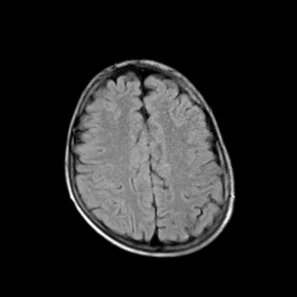 File:Cerebral tuberculoma (Radiopaedia 41152-43932 Axial FLAIR 17).jpg