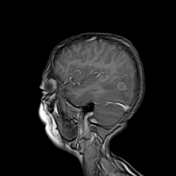 File:Cerebral tuberculoma (Radiopaedia 41152-43932 Sagittal T1 C+ 15).jpg