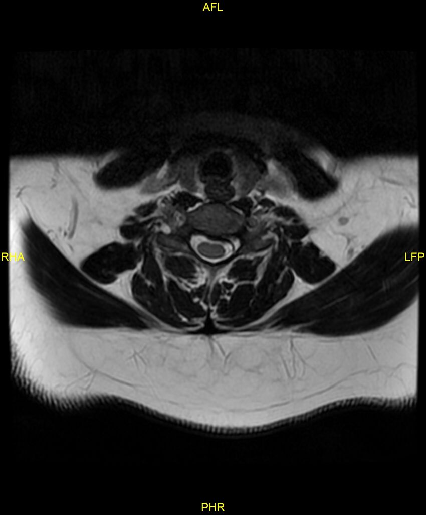 Cervical disc protrusion (Radiopaedia 87147-103415 Axial T2 42).jpg