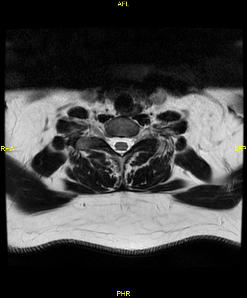 Cervical disc protrusion (Radiopaedia 87147-103415 Axial T2 64).jpg