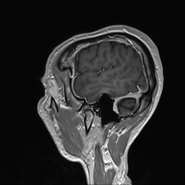File:Cervical dural CSF leak on MRI and CT treated by blood patch (Radiopaedia 49748-54995 G 108).jpg