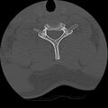 Cervical flexion teardrop fracture with cord hemorrhage (Radiopaedia 32497-33454 Axial bone window 65).jpg