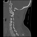 Cervical flexion teardrop fracture with cord hemorrhage (Radiopaedia 32497-33454 Sagittal bone window 29).jpg