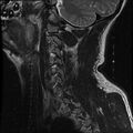 Cervical flexion teardrop fracture with cord hemorrhage (Radiopaedia 32497-33455 Sagittal T2 16).jpg