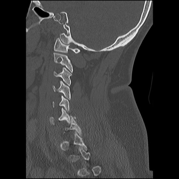 File:Cervical fracture and dislocation with locked facet (Radiopaedia 31837-32780 Sagittal bone window 26).jpg