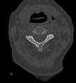 Cervical spine ACDF loosening (Radiopaedia 48998-54070 Axial bone window 22).png