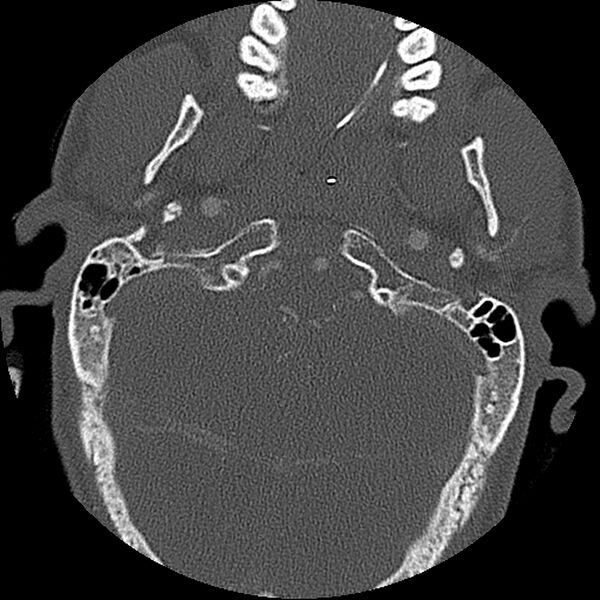 File:Cervical spine fractures with vertebral artery dissection (Radiopaedia 32135-33078 Axial bone window 76).jpg