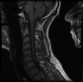 Cervical vertebrae metastasis (Radiopaedia 78814-91667 Sagittal T1 6).png