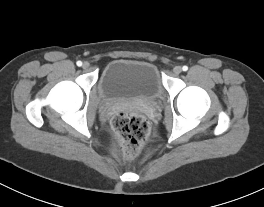 Cesarean scar endometriosis (Radiopaedia 82925-97262 A 83).jpg