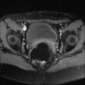 Cesarian section scar endometriosis (Radiopaedia 66520-75799 Axial T1 fat sat 17).jpg