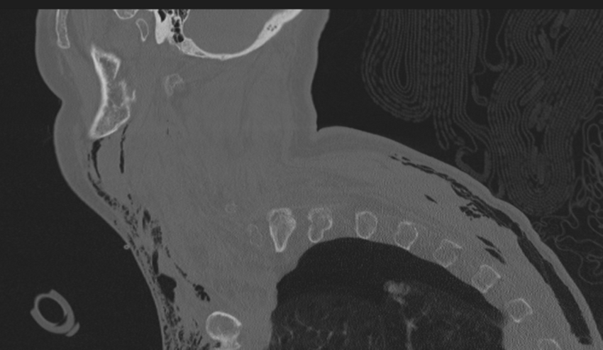 Chalk stick fracture (Radiopaedia 57948-64928 Sagittal bone window 5).png