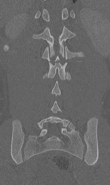 File:Chance fracture (Radiopaedia 40360-42912 Coronal bone window 49).png