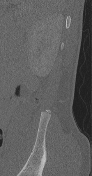 File:Chance fracture (Radiopaedia 40360-42912 Sagittal bone window 6).png