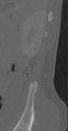 Chance fracture (Radiopaedia 40360-42912 Sagittal bone window 6).png
