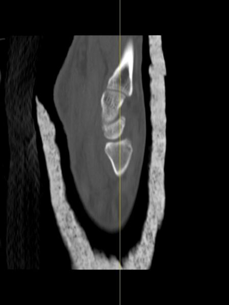 File:Chauffeur's (Hutchinson) fracture (Radiopaedia 58043-65079 Sagittal bone window 13).jpg